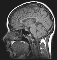 MRI_brain Psynso